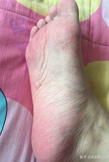 水泡型脚气即时更换潮湿袜子(图1) 水泡型脚气即时更换潮湿袜子