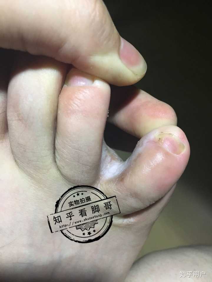 红斑型脚气泛红原理(图1) 红斑型脚气泛红原理