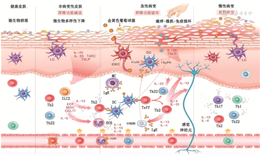 红斑型脚气炎症机制(图1) 红斑型脚气炎症机制