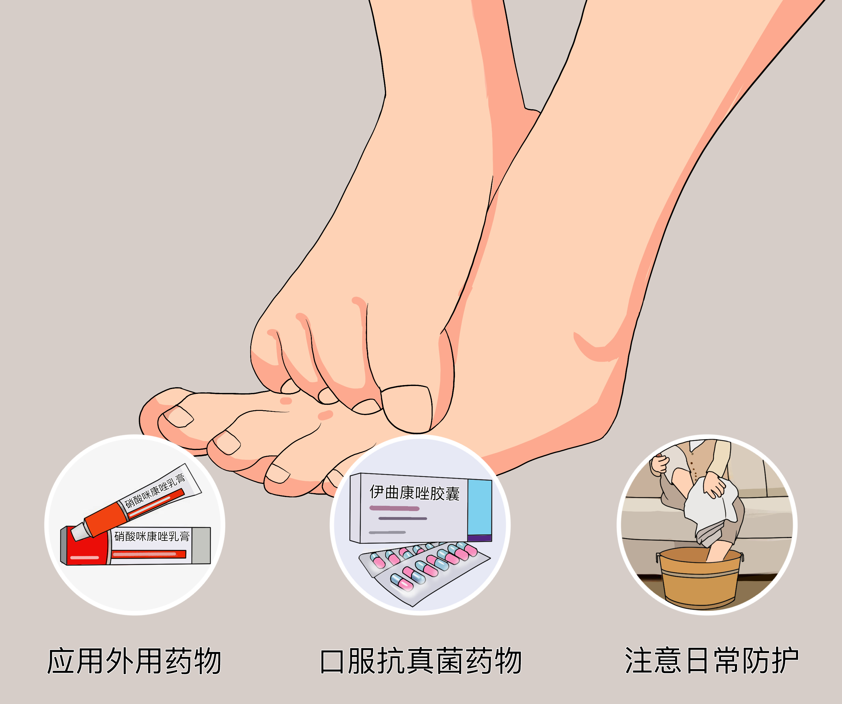 【医生提醒】脚气用药的注意事项(图1) 【医生提醒】脚气用药的注意事项