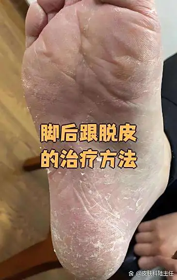 改善摩擦挤压脚脱皮