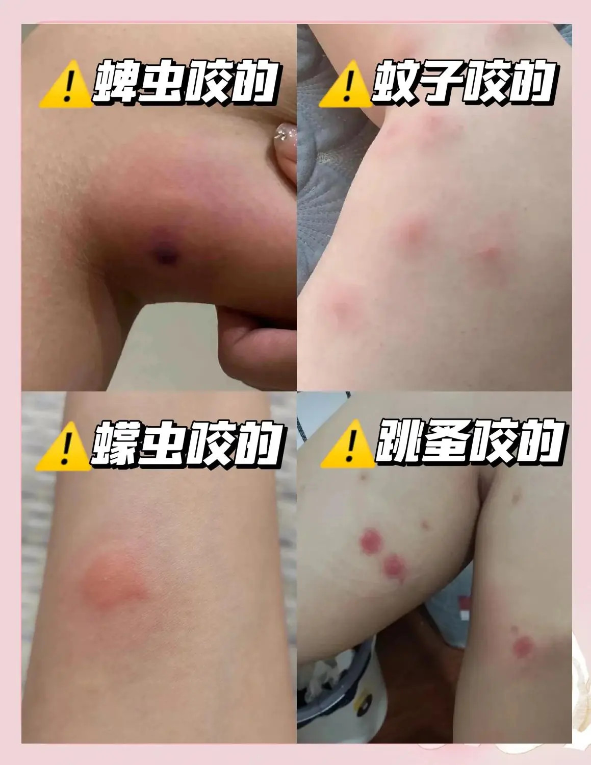 改善蚊虫叮咬后脱皮