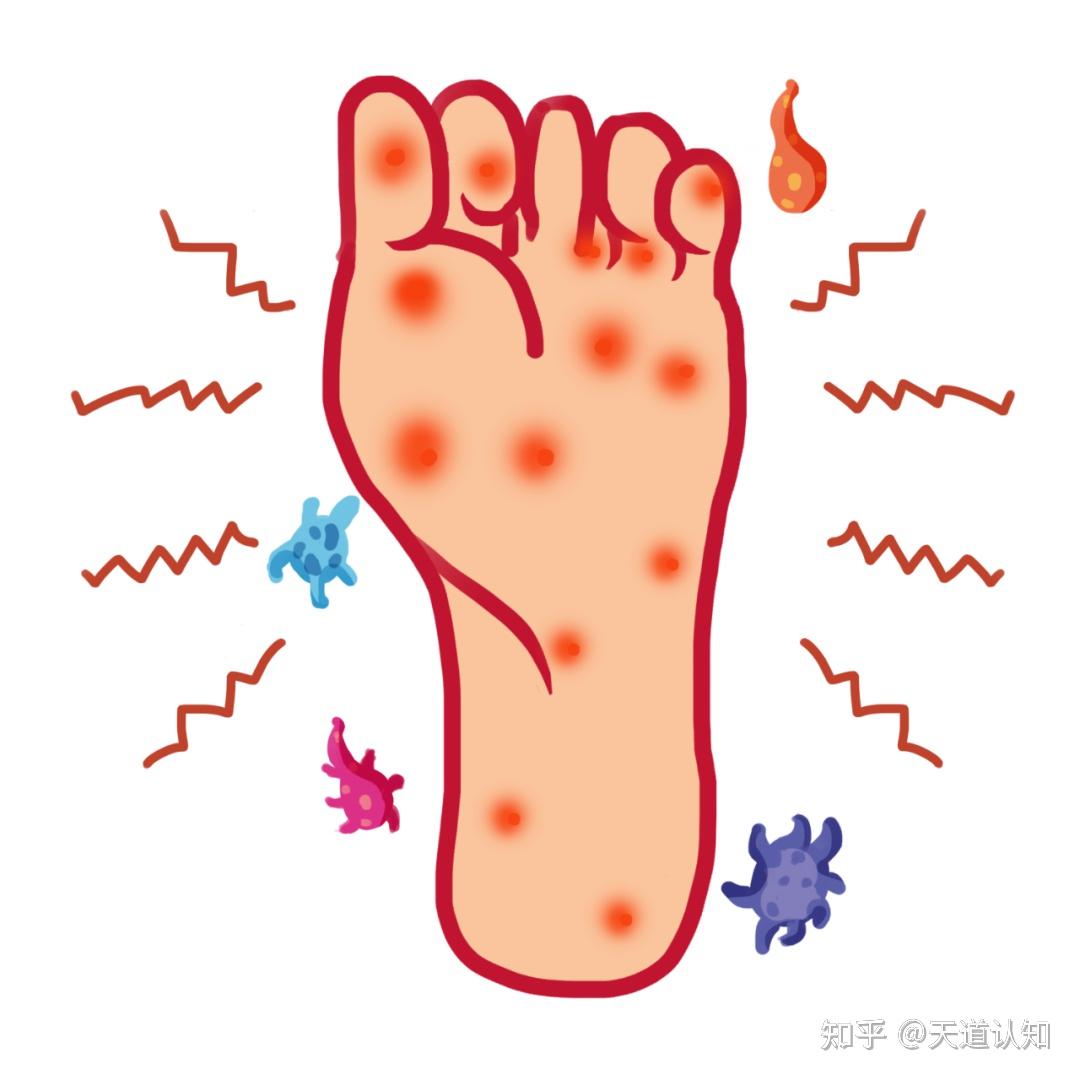 红斑型脚气合并异味诱因