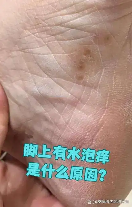 脚部起水泡外用膏剂过敏(图1) 脚部起水泡外用膏剂过敏