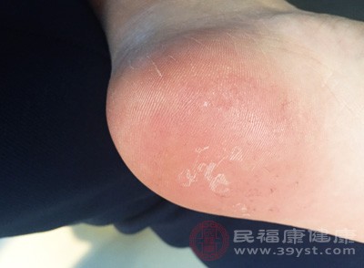 脚部起水泡碎石摩擦表皮