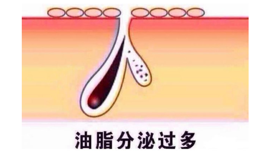 改善脚部油脂分泌旺盛(图1) 改善脚部油脂分泌旺盛
