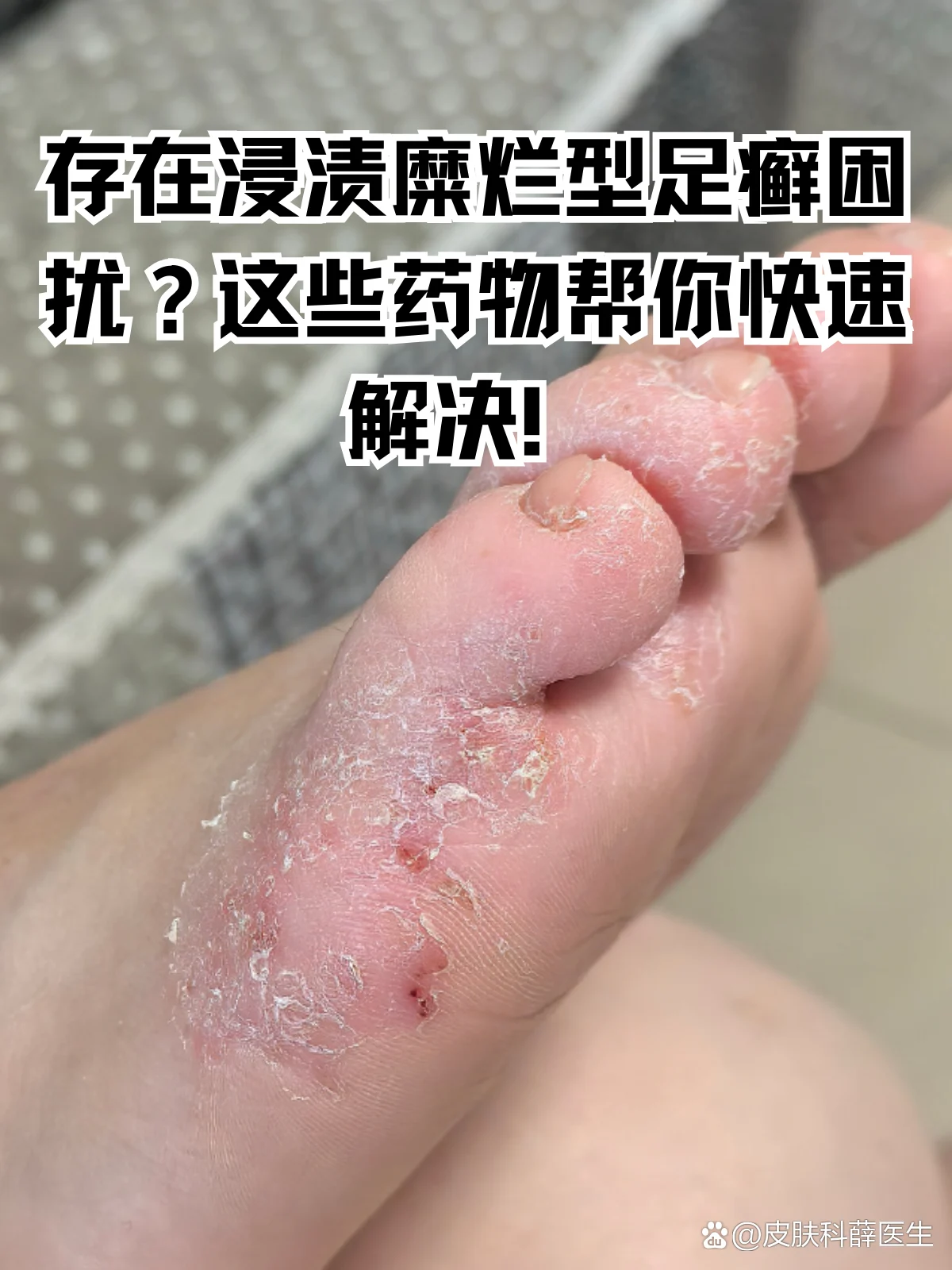 脚部异味潮湿浸渍诱发
