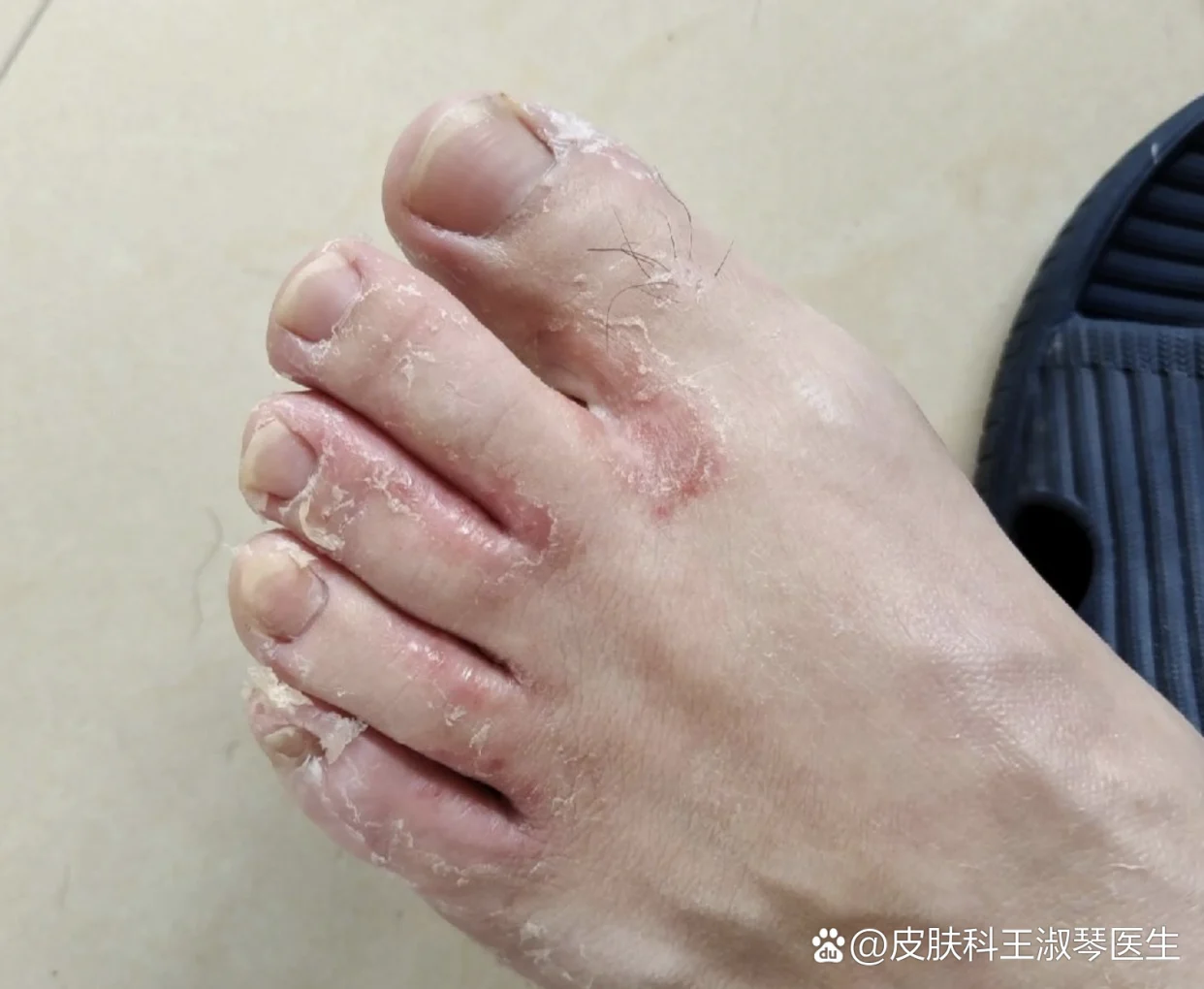 改善脚缝白皮堆积