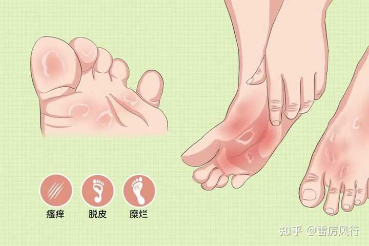 脚部起水泡瘙痒抓挠破损起疱