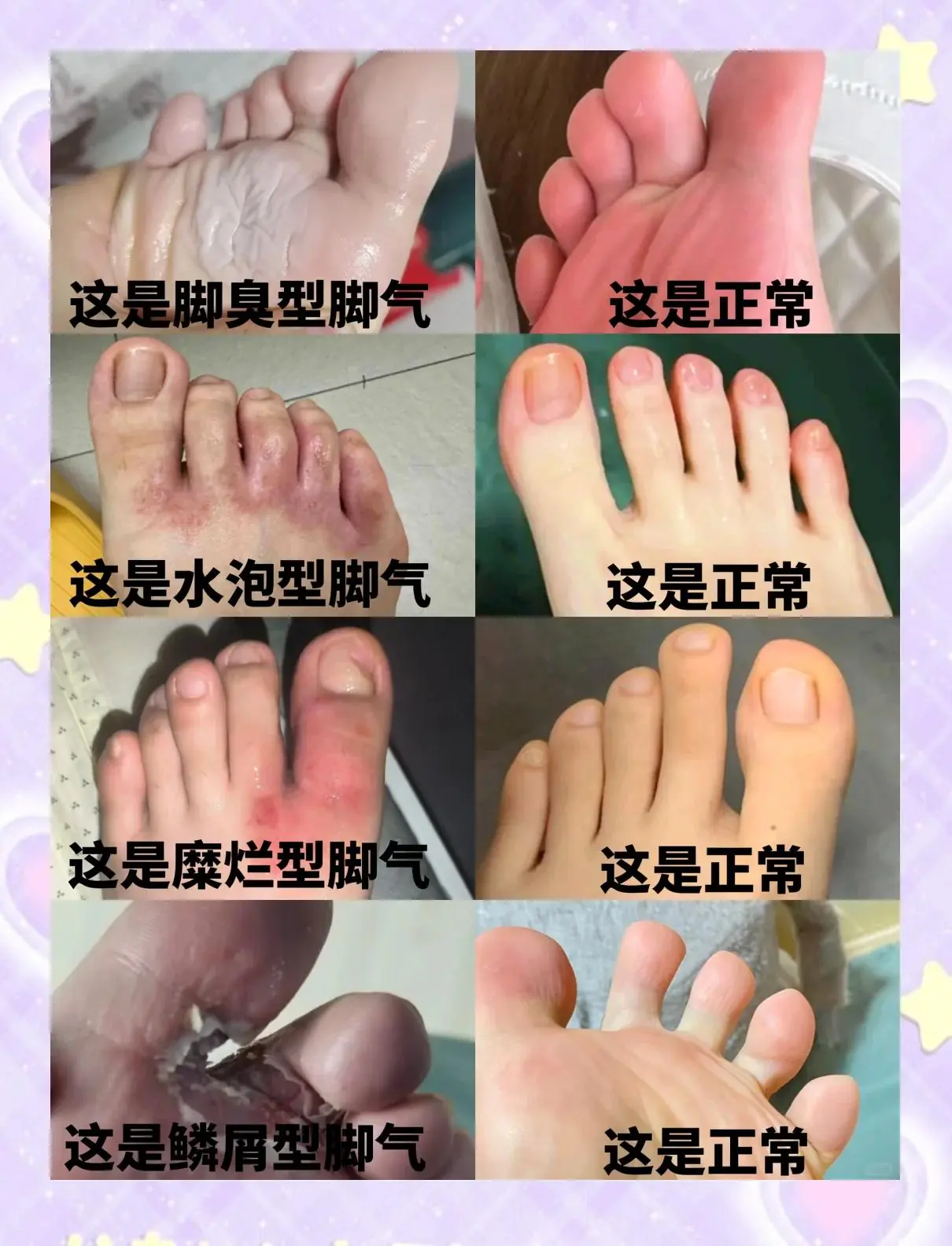 红斑型脚气鞋袜选择标准