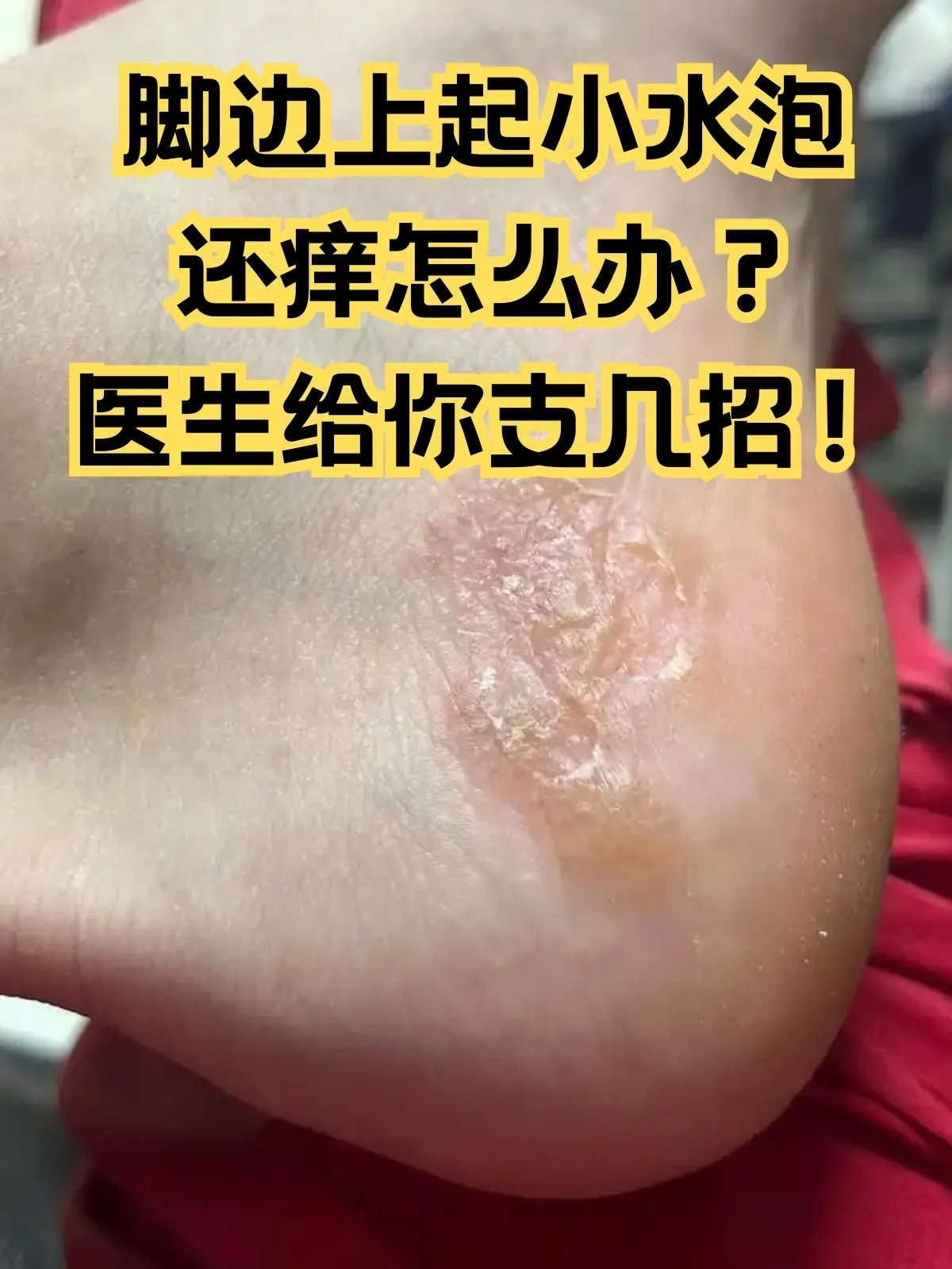 脚部起水泡密集小水泡诱因(图1) 脚部起水泡密集小水泡诱因