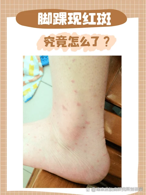 红斑型脚气鞋子材质要求(图1) 红斑型脚气鞋子材质要求