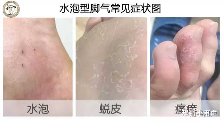 脚部异味足部汗液浸渍