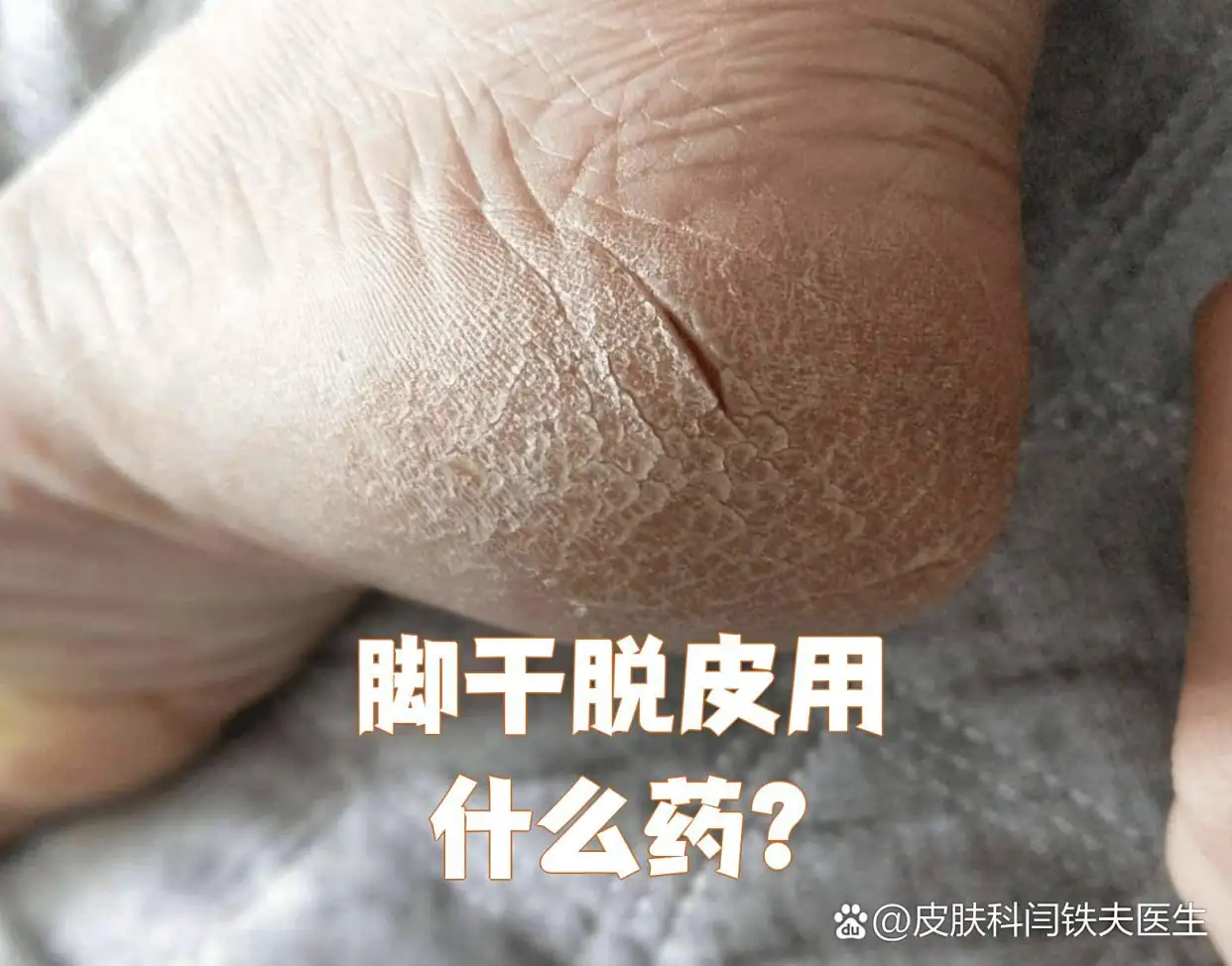 改善脚部干纹脱皮