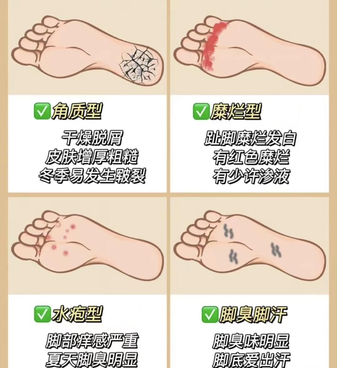 脚部异味轻微溃烂隐藏异味