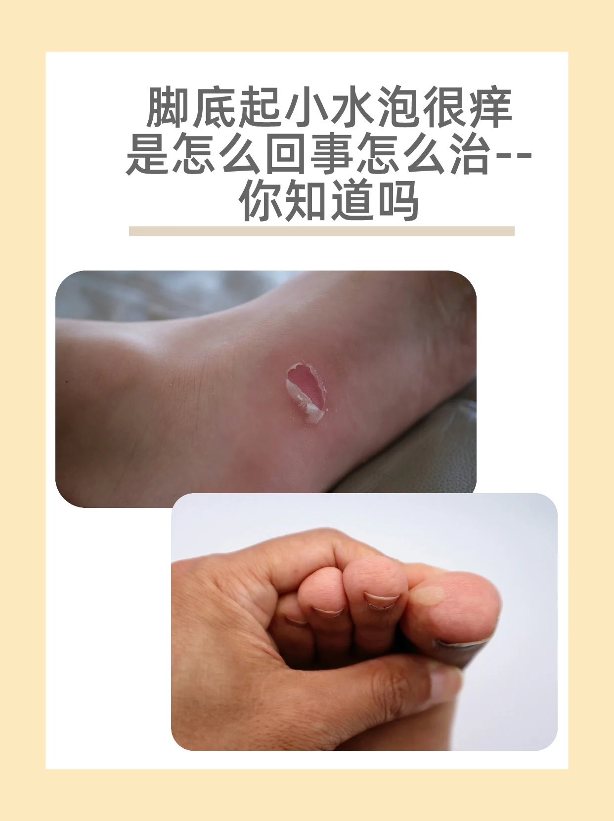 脚部水疱点状小泡护理