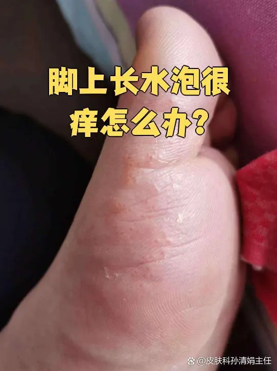 脚部水疱连片水泡修护