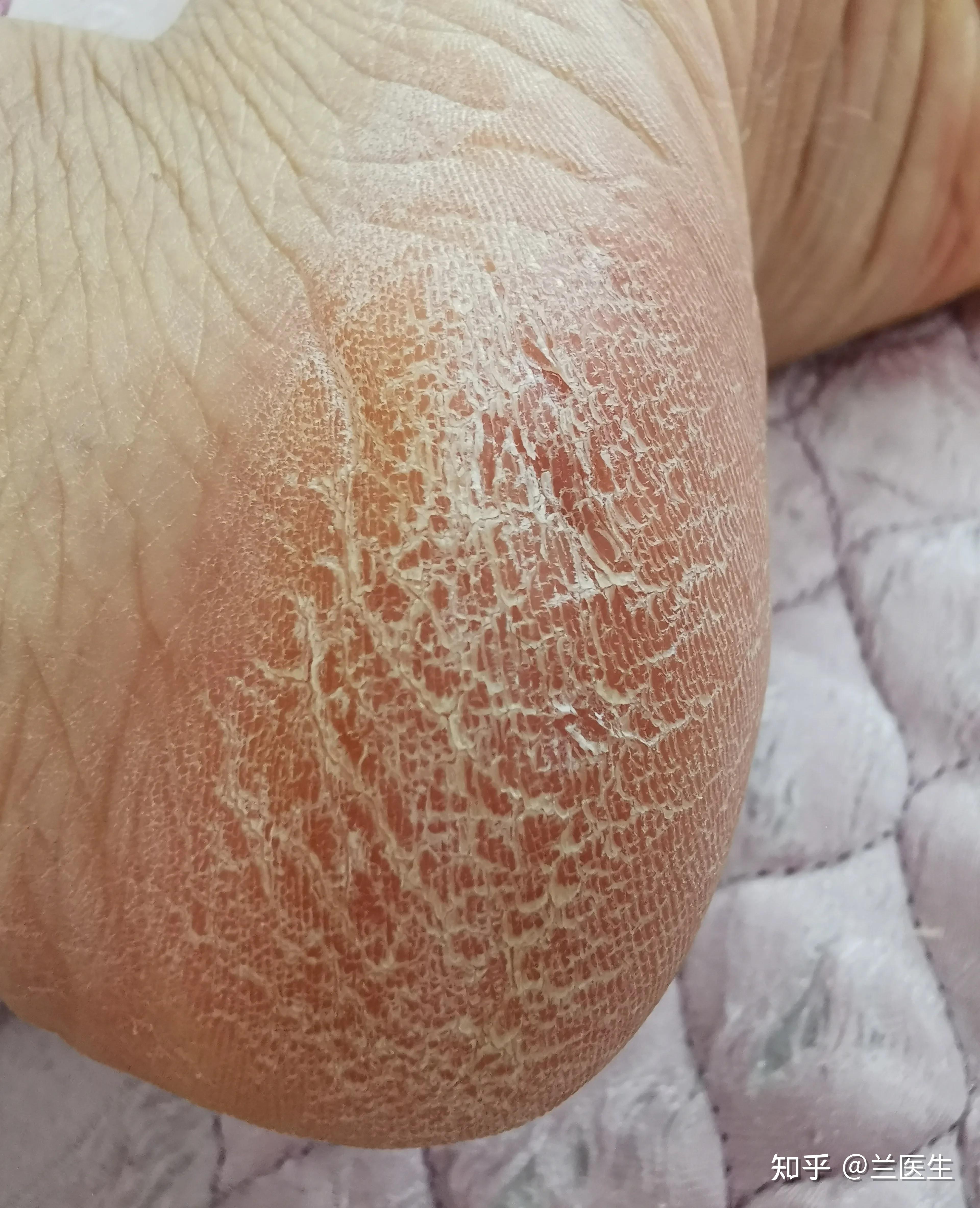 脚部异味隐性裂口堆积污垢