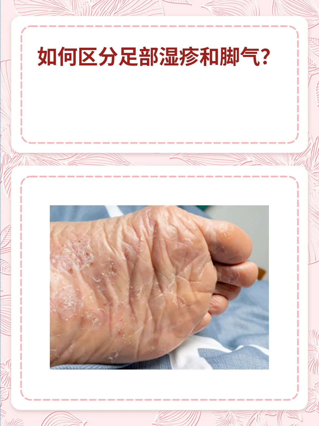 脚部异味盆地湿气滞留足部