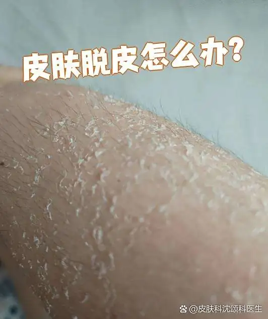 民间温和去脱皮妙招