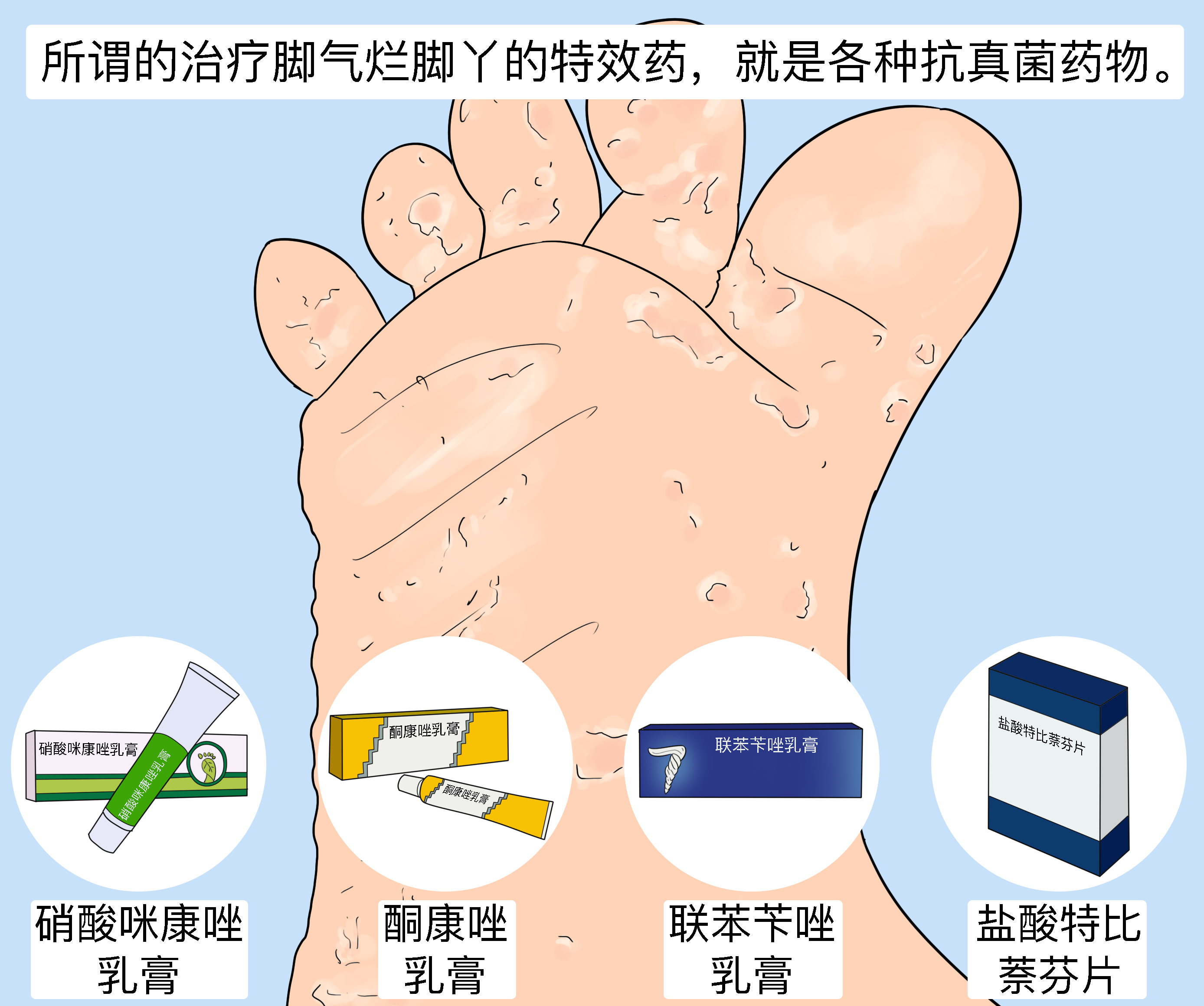 糜烂型脚气外用药物涂抹技巧