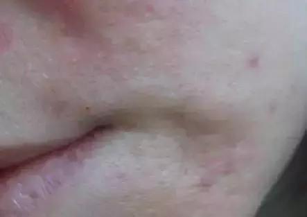 脚部水疱裂缝水泡处理