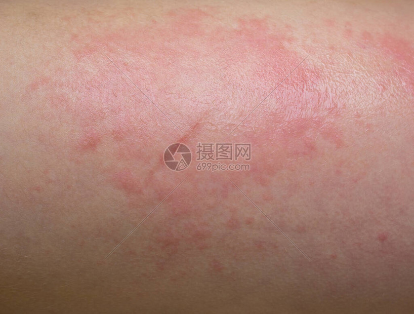 过敏性红斑治疗技巧(图1) 过敏性红斑治疗技巧