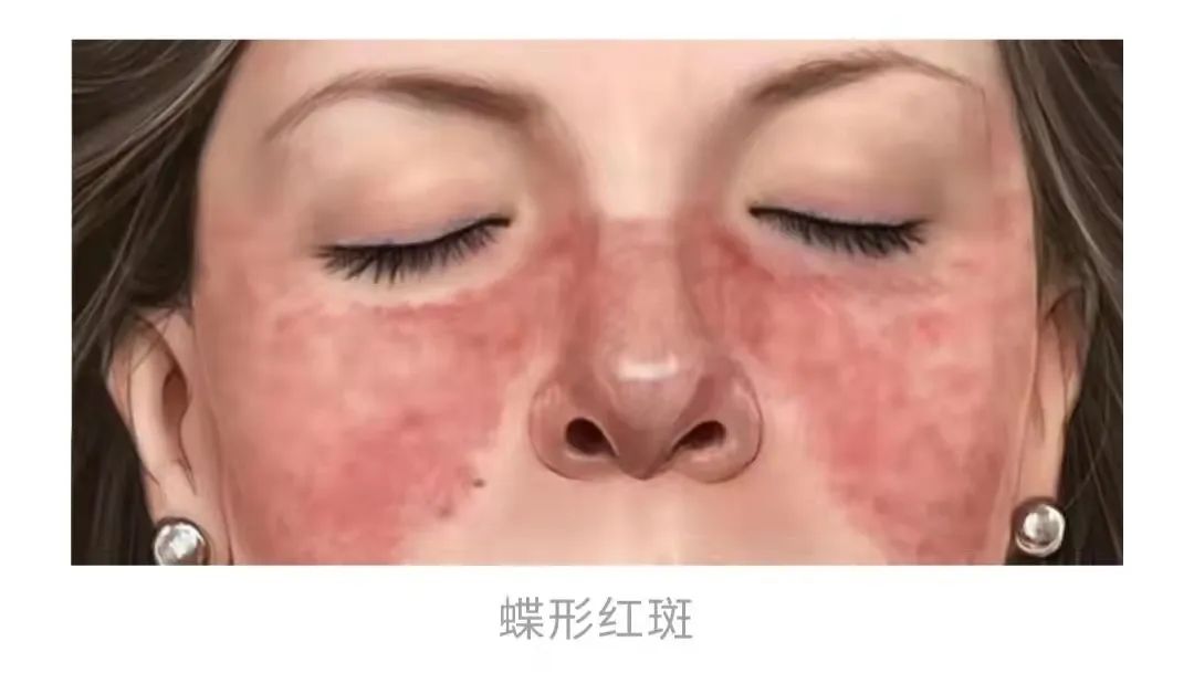红斑脚气治疗细节
