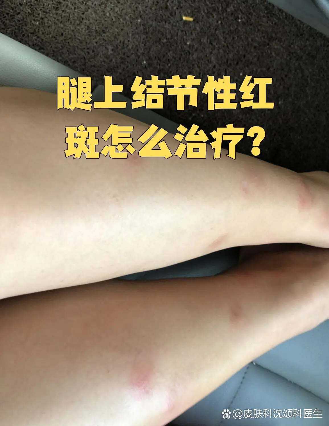 脚部红斑治疗期间生活习惯