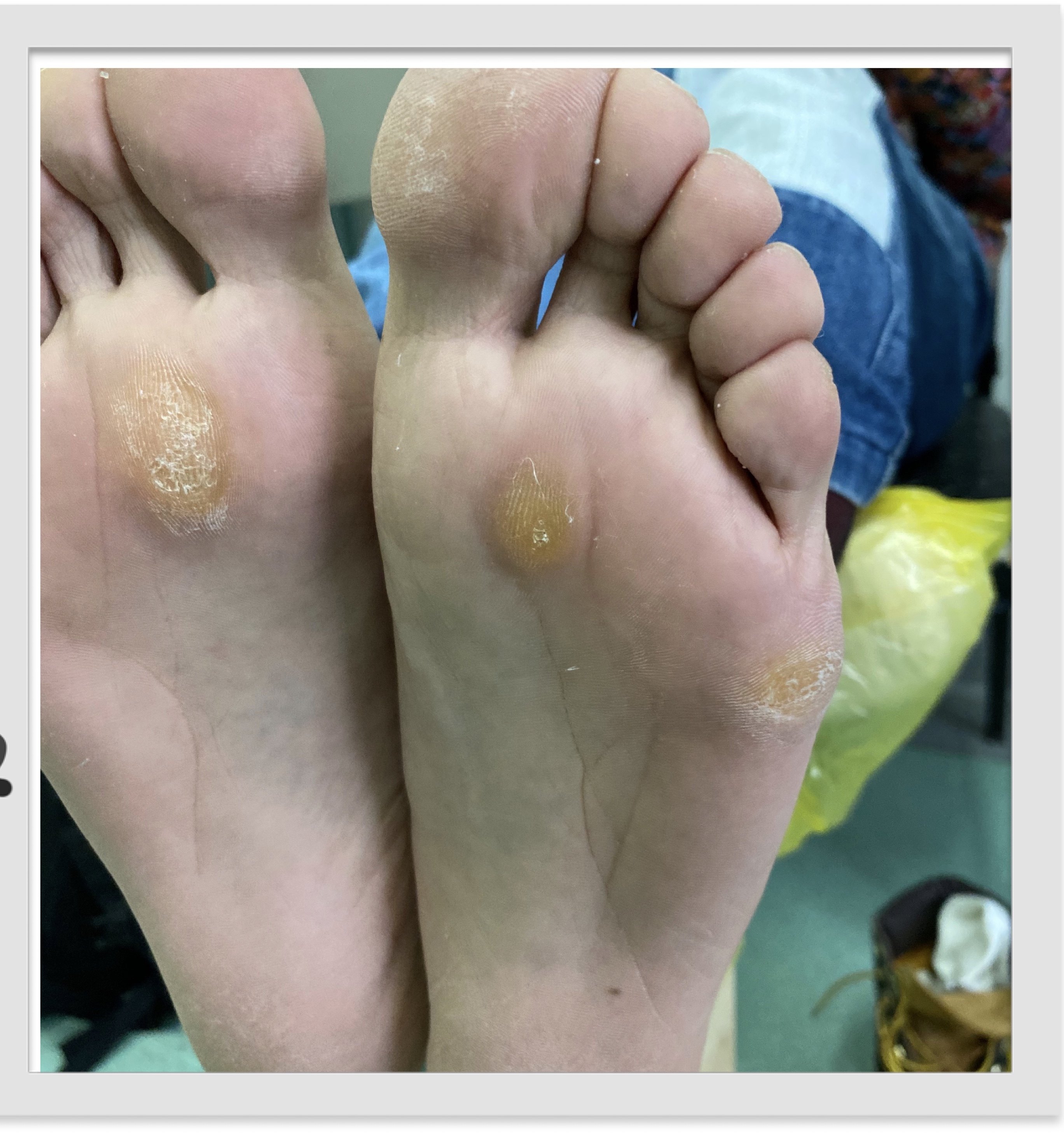 如何定期打磨老茧除味