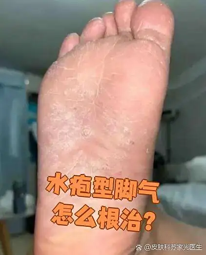 水疱型脚气运动装备选择(图1) 水疱型脚气运动装备选择