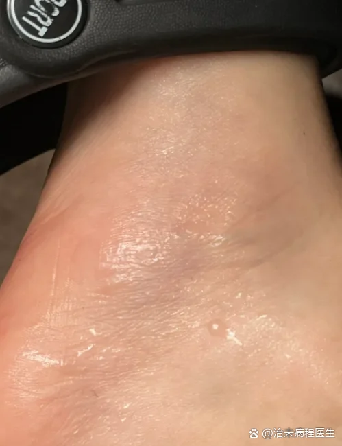 脚部糜烂出汗后快速处理技巧