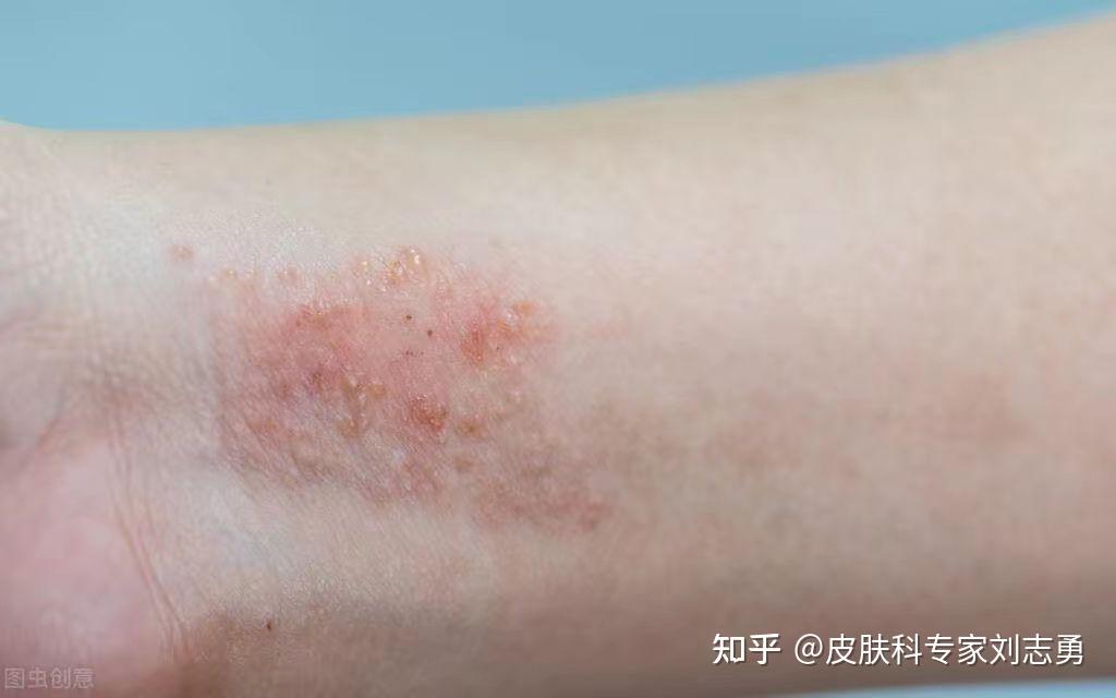 接触性皮炎后期脱屑(图1) 接触性皮炎后期脱屑