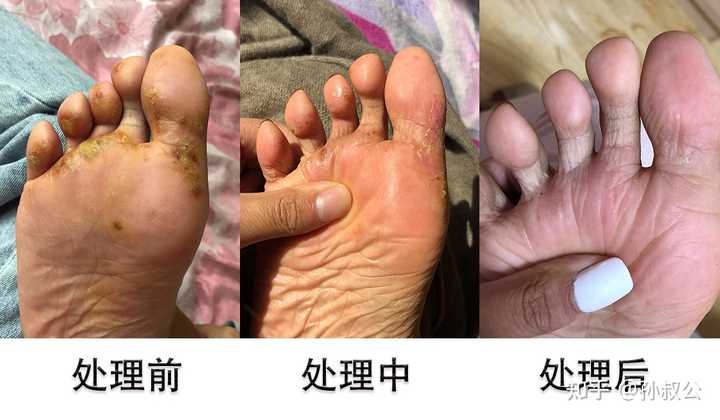 脚部糜烂泛红后快速淡化方法