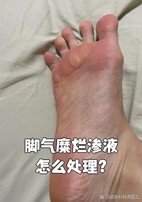 脚部糜烂渗液后快速收敛方案(图1) 脚部糜烂渗液后快速收敛方案