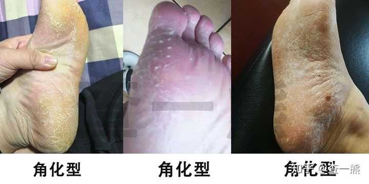 足部清洁过度破坏角质