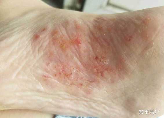水疱型脚气脚部死角抑菌(图1) 水疱型脚气脚部死角抑菌