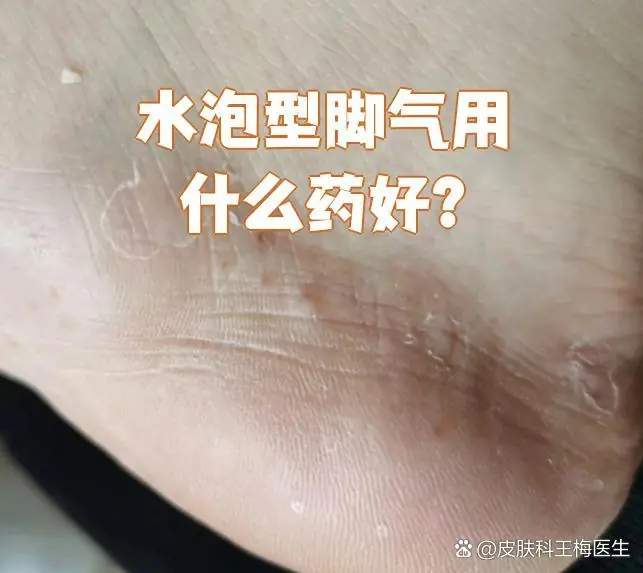 水疱型脚气个人脚盆专属使用(图1) 水疱型脚气个人脚盆专属使用