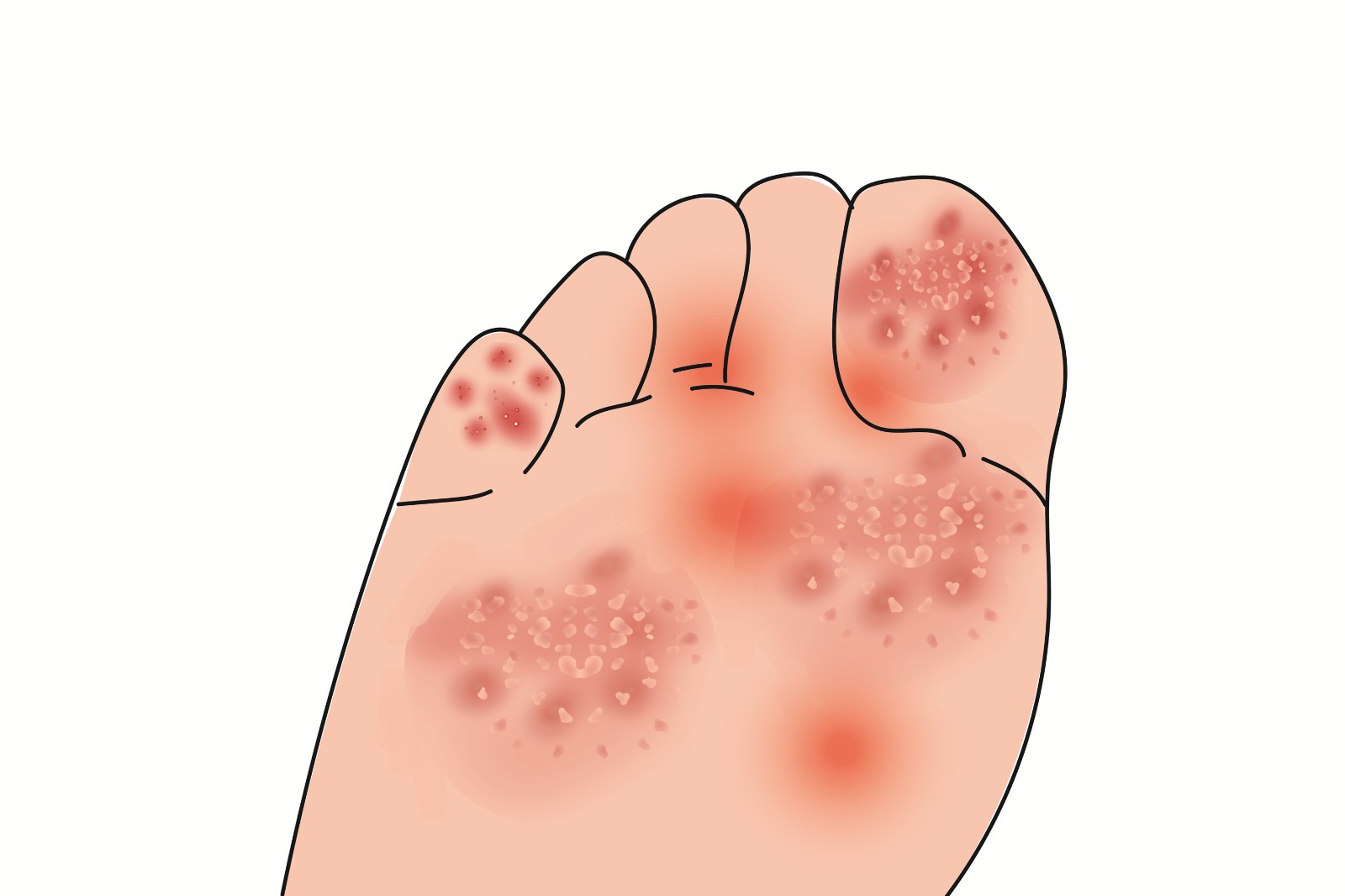 脚部红斑慢性炎症成因