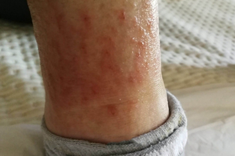 脚部红斑急性炎症诱发