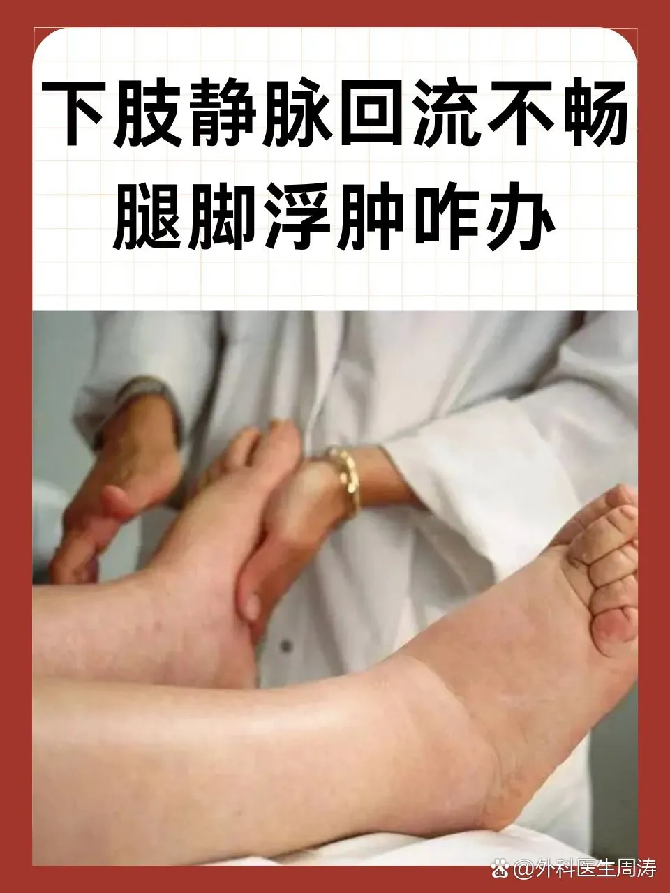 脚部水疱下肢静脉不畅