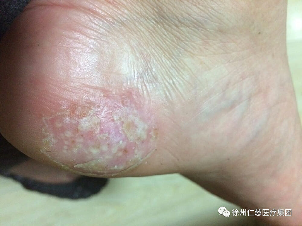 脚部水疱碎石杂质诱发磨损