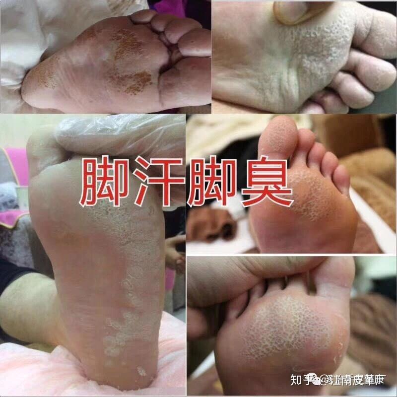 鳞屑脚气出汗后白屑变多