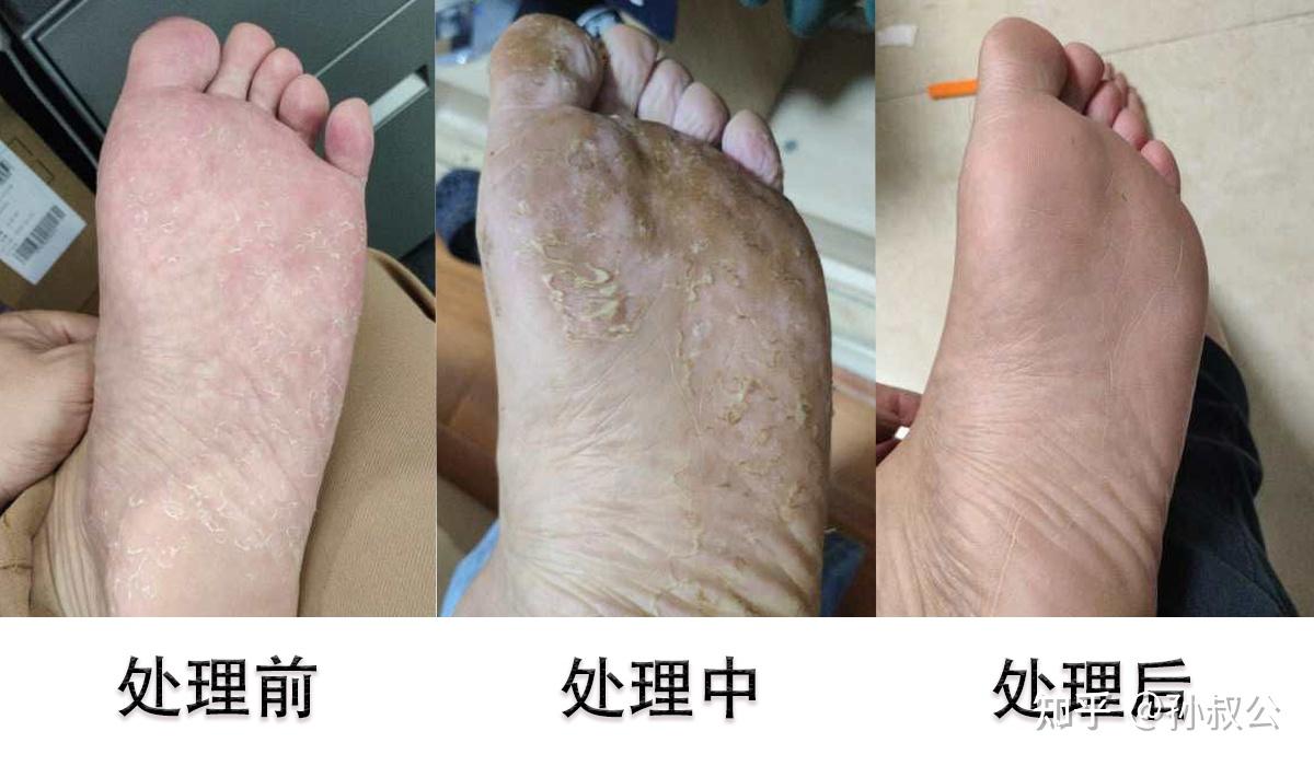 红斑型脚气鞋袜选择误区