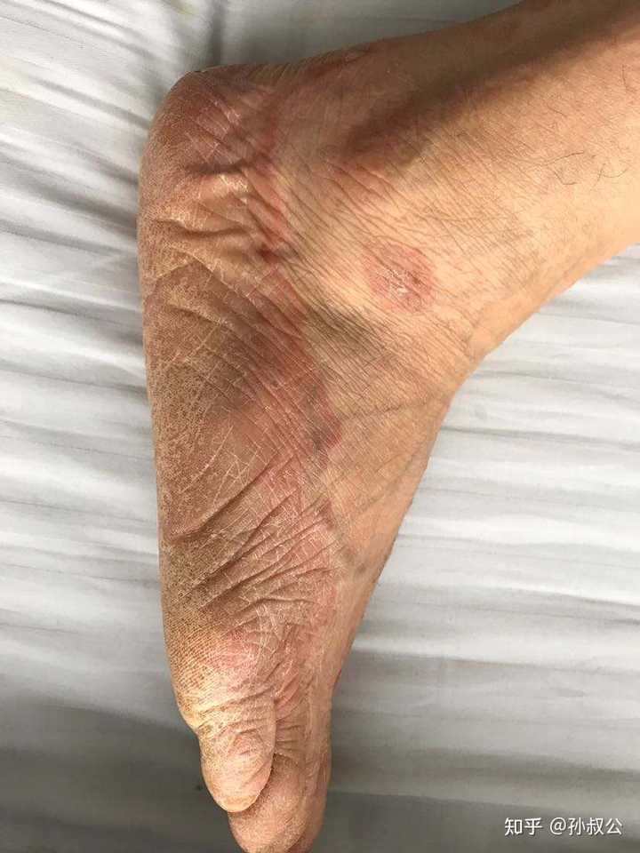 鳞屑脚气环境潮湿滋生