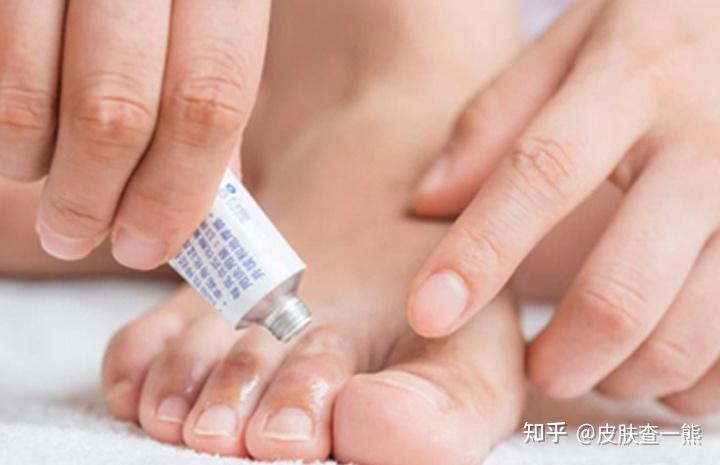 异味型脚气激素药膏滥用危害