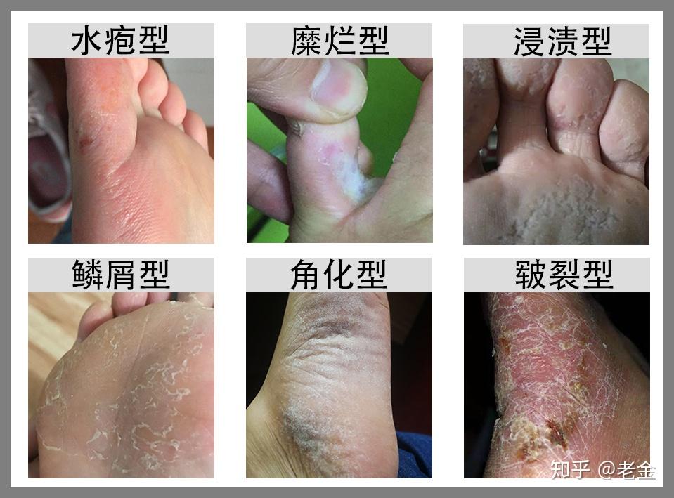 脚部水疱高湿度促进霉菌生长