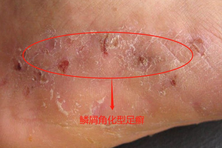 红斑型脚气手撕皮屑危害