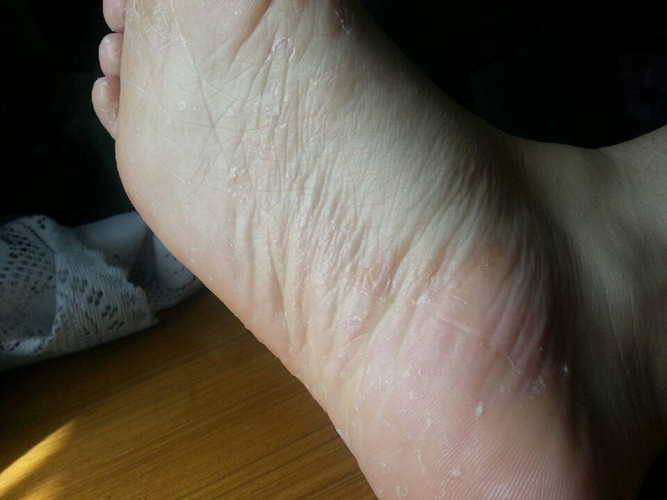 红斑型脚气烫脚危害