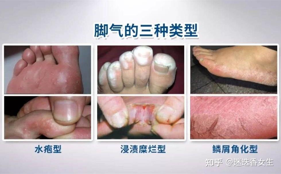 红斑型脚气外界刺激规避方法